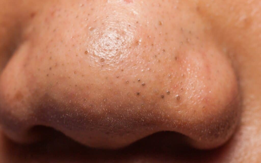Blackheads on Nose - Causes, Remedies, and Prevention Tips