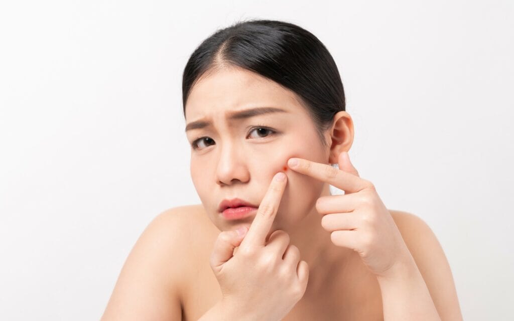 How to Get Rid of a Pimple Overnight: 10 Proven Methods and Essential Tips