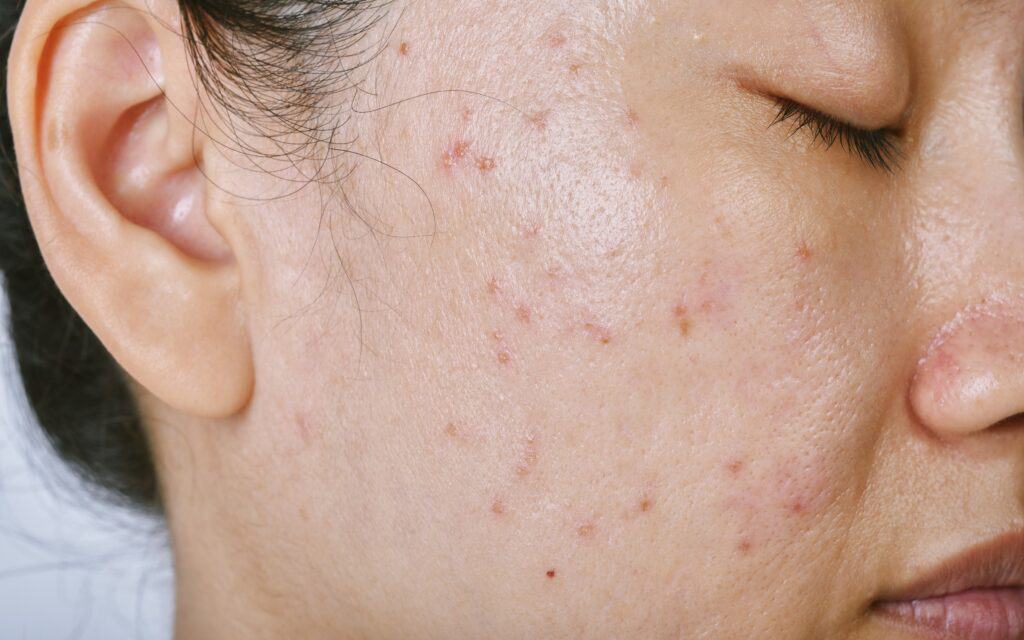 Understanding Acne Papules: Causes, Treatment, and Prevention Strategies - The Derm Spot