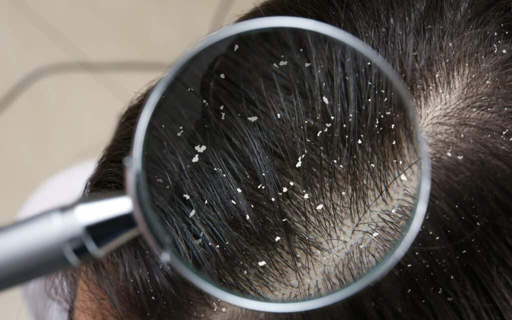 How to get rid of dandruff - The Derm Spot