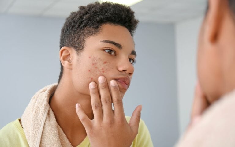 Banishing Acne Scars: Mastering Hyperpigmentation for Flawless Skin