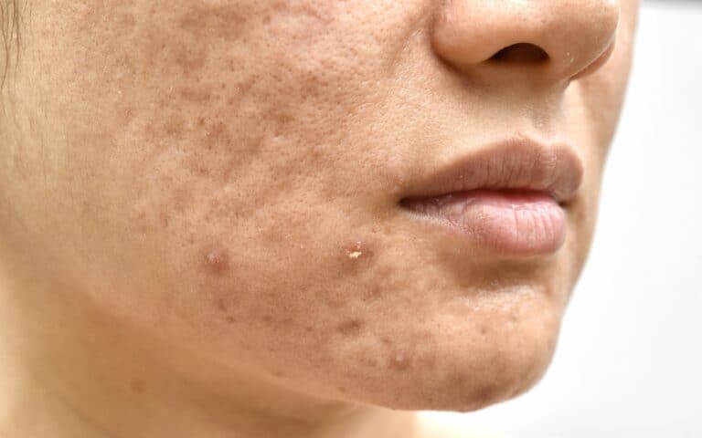 Erasing Acne Scars: Unveiling the Power of Laser Treatment in 100 Characters or Less