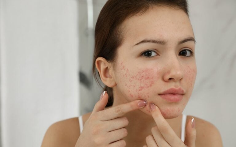 Fungal Acne Treatment at Home: Natural Remedies, Prevention Tips, and Expert Advice