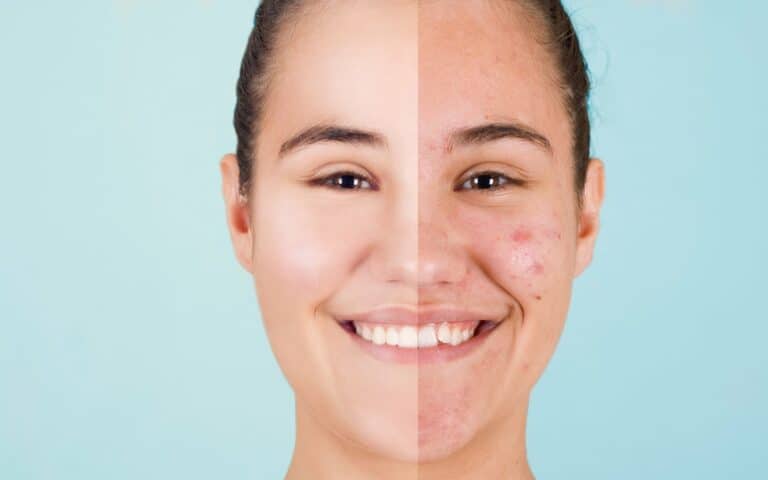 Nodules No More: Effective Treatments and Tips for Clearing Acne