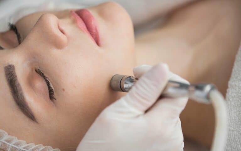 Reveal Your Skin's Hidden Beauty: Microdermabrasion for Acne Scars