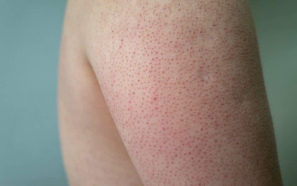Smooth Skin Secrets: Banishing Strawberry Skin for Good!