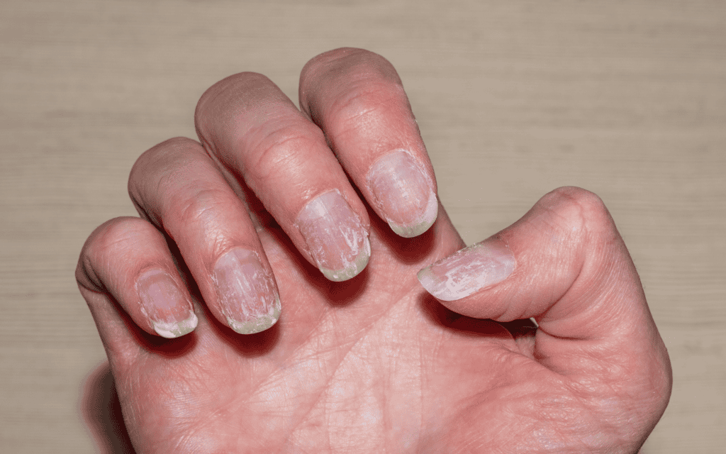 A close-up of a hand with fingernails showing signs of damage, peeling, and rough texture against a light background.