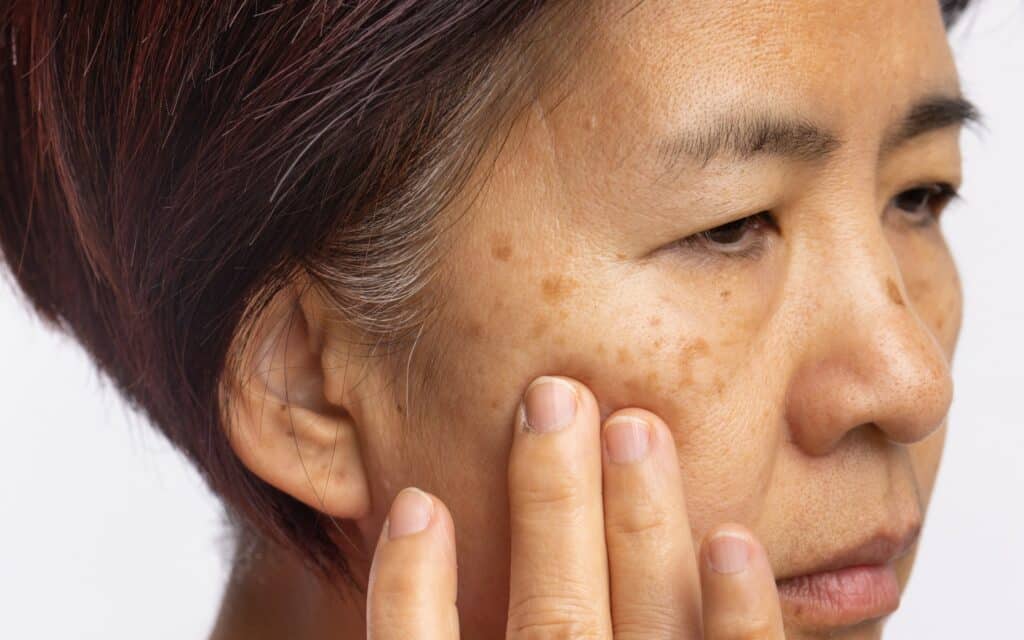 Close-up of a woman touching her cheek, showing visible dark spots and uneven skin tone on her face.
