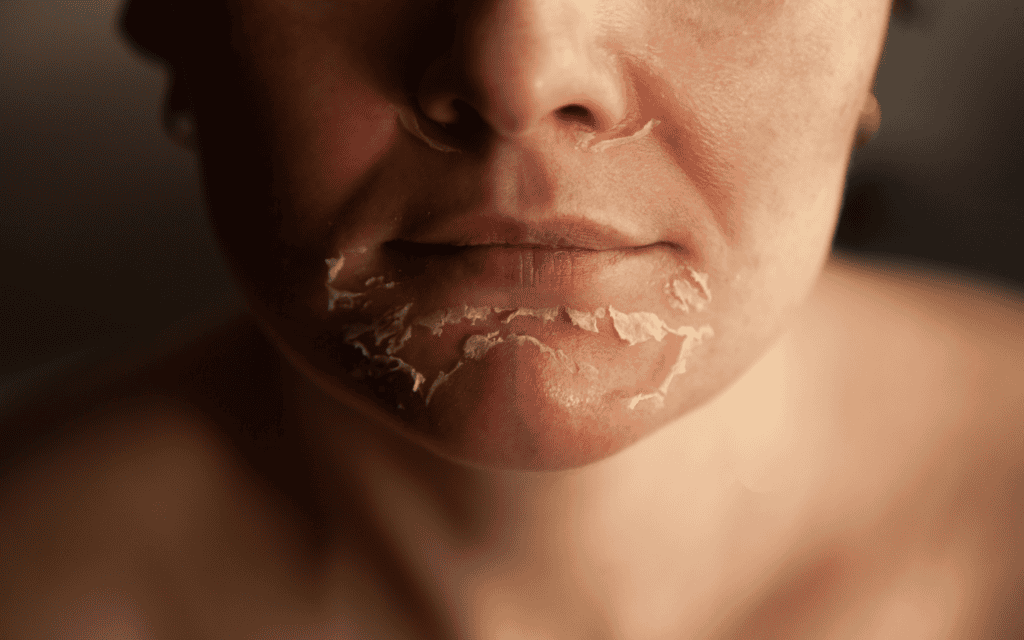 Close-up of the lower face of a person with dry, peeling skin around the mouth and chin area.