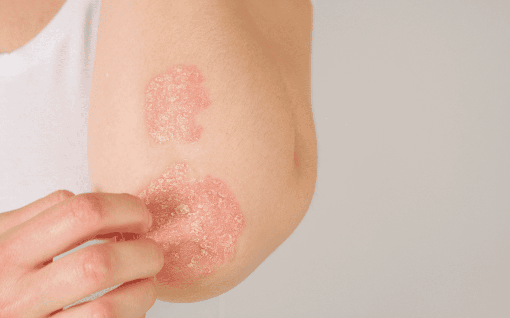 A person scratching red, scaly patches on the skin of their elbow, which appear to be symptoms of a skin condition.
