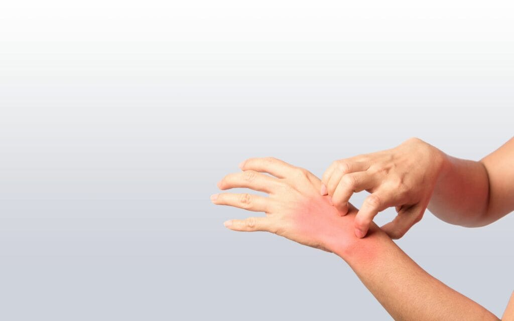 A person scratching the red, irritated skin on the back of their hand, indicating possible itching or allergic reaction.