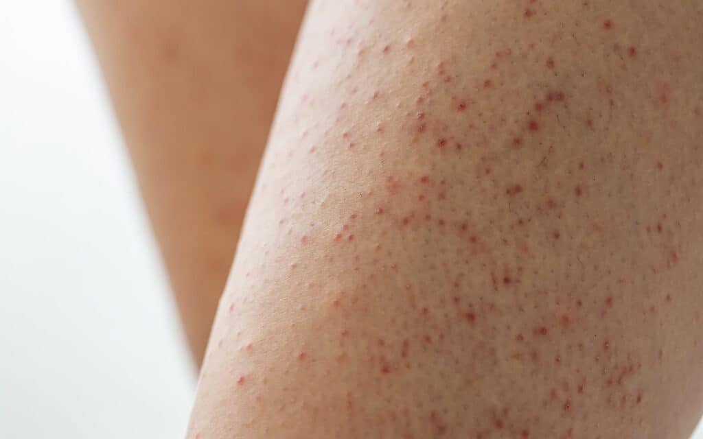 Close-up of skin on a leg with numerous small red bumps and spots, indicating irritation or a possible rash.