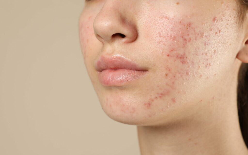 Close-up of a person's lower face showing red acne spots and blemishes on the cheek and jawline against a neutral background.